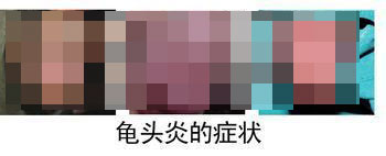 河池男性龟头炎如何检查 河池男性龟头炎如何检查