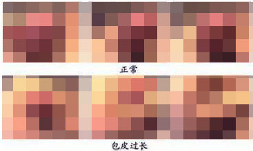 河池男性包皮过长造成的危害有哪些 河池男性包皮过长造成的危害有哪些