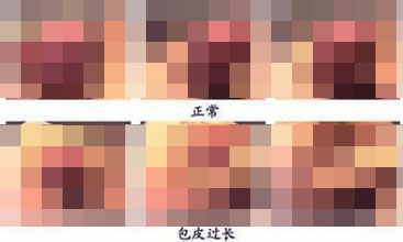 河池男性包皮过长必须要手术吗