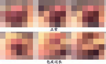 河池男性包皮过长对女性有影响吗 河池男性包皮过长对女性有影响吗