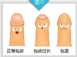 割包皮手术后要怎样护理 割包皮手术后要怎样护理