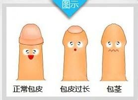 包皮包茎手术多少钱呢? 包皮包茎手术多少钱呢?