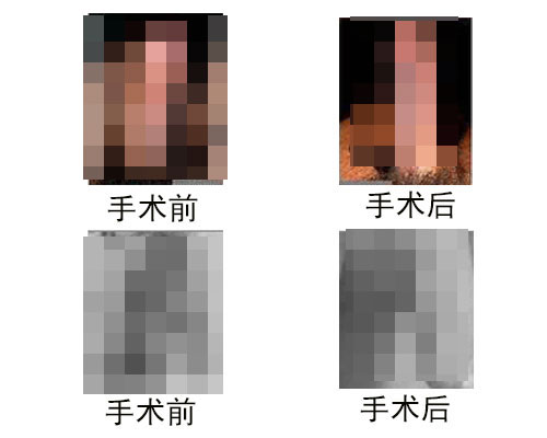 包皮手术哪个好? 包皮手术哪个好?