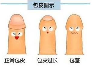 割包皮有没有副作用呢? 割包皮有没有副作用呢?