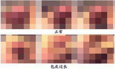 男性包皮过长会引发哪些疾病? 男性包皮过长会引发哪些疾病?