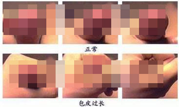 包皮过长不割除可以吗? 包皮过长不割除可以吗?