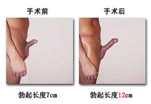 如何让阴茎二次发育? 如何让阴茎二次发育?