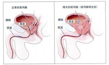 前列腺增生要做什么检查 前列腺增生要做什么检查