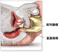 患上前列腺结石有哪些症状