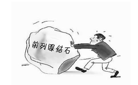 前列腺结石 前列腺结石