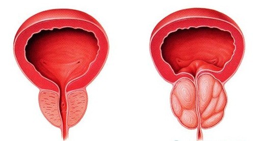 前列腺囊肿会传染 前列腺囊肿会传染
